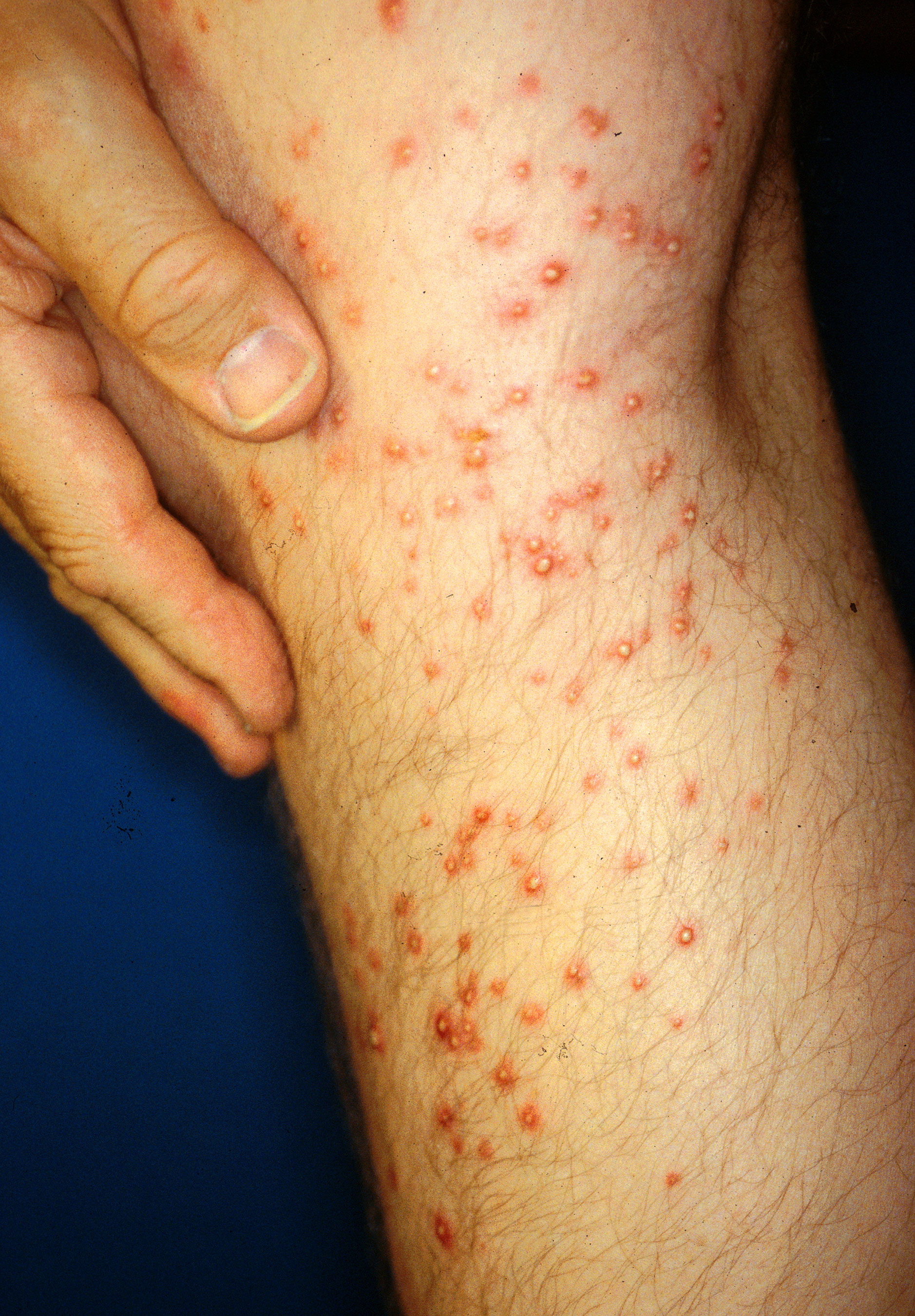 In less than 10 seconds, an unwary scientist was stung more than 250 times on one leg when he carelessly knelt on a collapsed fire ant mound. The sterile pustules developed to this stage in three days. Image and cutline courtesy of USDA National Agricultural Library Image Galleries. Photo by Daniel Wojcik. 